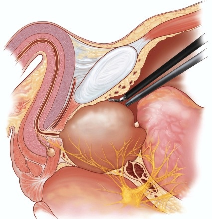 prostatectomia