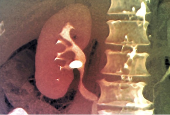 renal