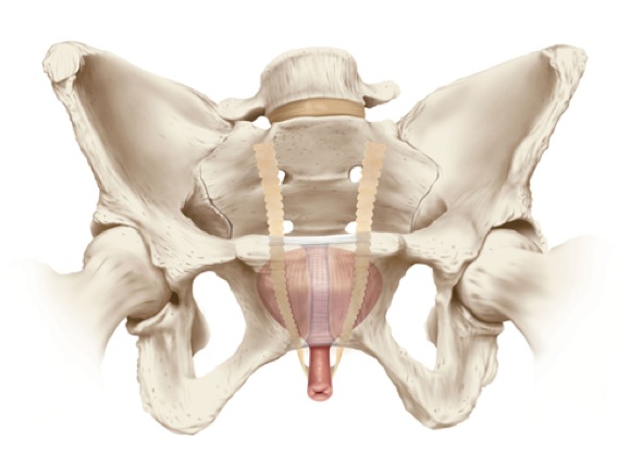 cabestrillo uretral